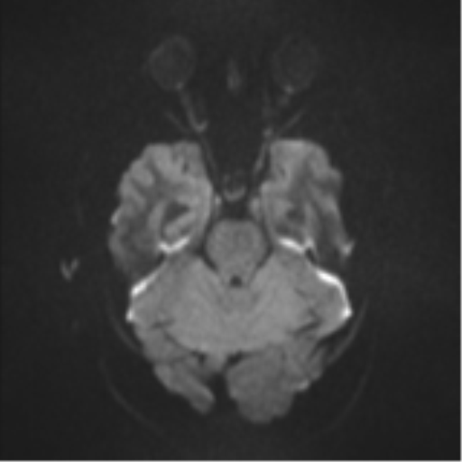Colloid cyst (Radiopaedia 44510-48181 Axial DWI 36).png