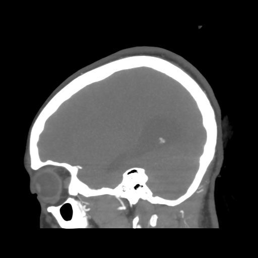 File:Colloid cyst (resulting in death) (Radiopaedia 33423-34499 B 15).png