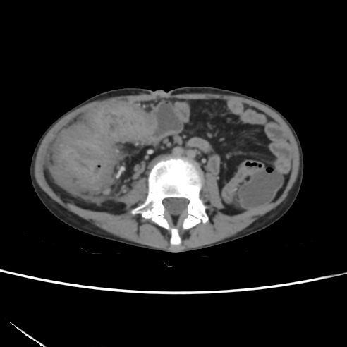 File:Colocolic fistula - Crohn disease (Radiopaedia 57063-63955 A 46).jpg
