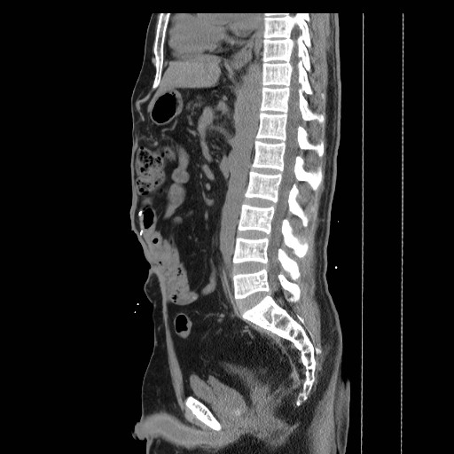 File:Colocutaneous fistula in Crohn's disease (Radiopaedia 29586-30093 C 26).jpg