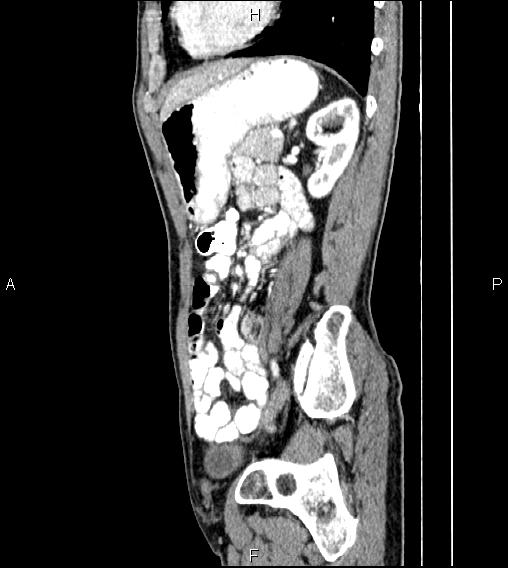 Colon adenocarcinoma - hepatic flexure (Radiopaedia 85635-101395 D 62).jpg