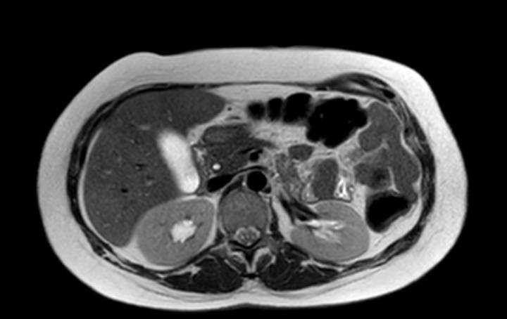 Colon adenocarcinoma with Krukenberg tumors, advanced pregnancy (Radiopaedia 67279-76645 Axial T2 57).jpg