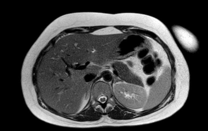 Colon adenocarcinoma with Krukenberg tumors, advanced pregnancy (Radiopaedia 67279-76645 Axial T2 64).jpg