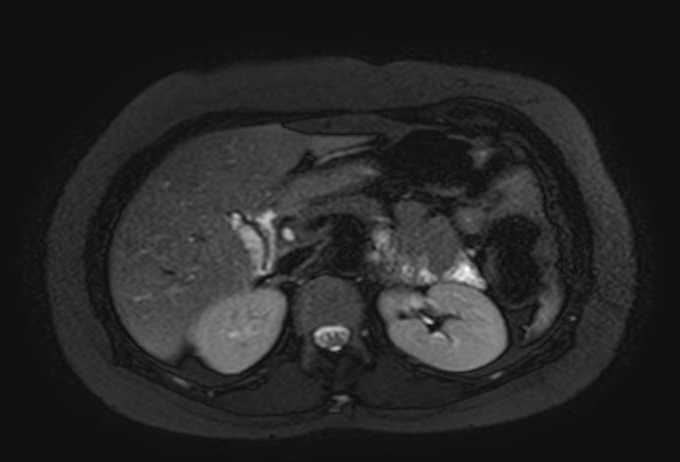 Colon adenocarcinoma with Krukenberg tumors, advanced pregnancy (Radiopaedia 67279-76645 Axial T2 SPAIR 59).jpg