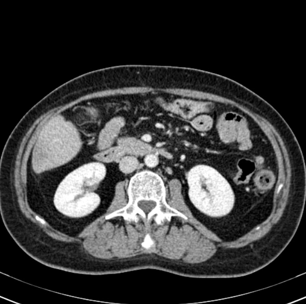 Colon carcinoma with hepatic metastases (Radiopaedia 29477-29961 A 51).jpg