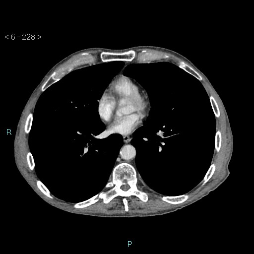 Colonic cancer (ultrasound and TC imaging) (Radiopaedia 50346-55713 B 228).jpg