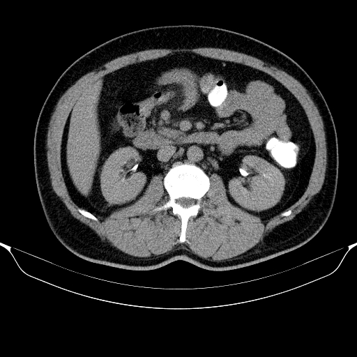 Colonic lipoma with colo-colic intussusception (Radiopaedia 58944-66200 Axial C+ rectal 25).jpg