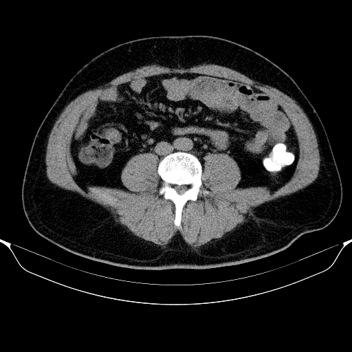 Colonic lipoma with colo-colic intussusception (Radiopaedia 58944-66200 Axial C+ rectal 39).jpg