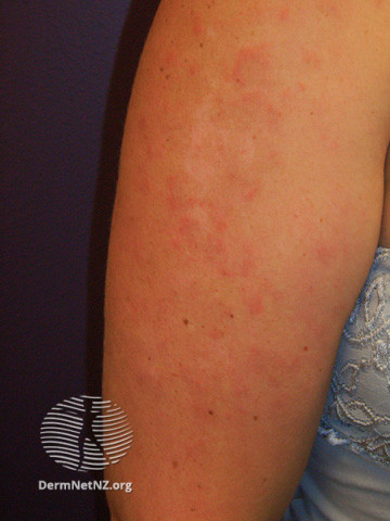 Cutaneous lupus erythematosus (DermNet NZ immune-lupus-erythematosus-2545).jpg