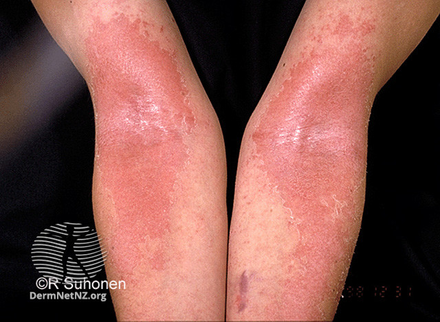 File:Elbow crease (DermNet NZ dermatitis-s-atopic14).jpg