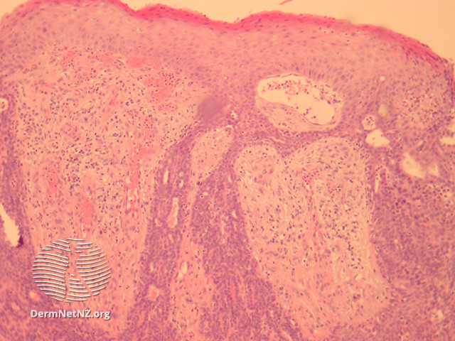 File:Figure 2 (DermNet NZ pathology-e-aggressive-adenocarcinoma-fig2).jpg