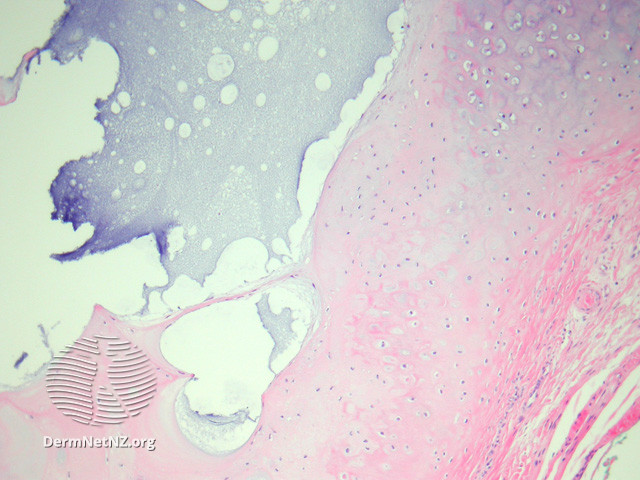 File:Figure 2 (DermNet NZ pathology-e-auricle-pseudocyst-figure-2).jpg