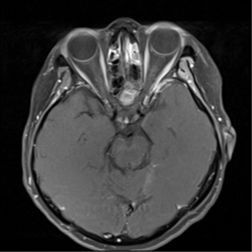 File:Nasopharyngeal carcinoma with cerebral abscess (Radiopaedia 43018-46273 Axial T1 C+ fat sat 10).png