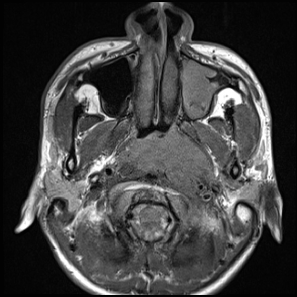 Nasopharyngeal carcinoma with skull base invasion (Radiopaedia 53415-59485 Axial T1 30).jpg