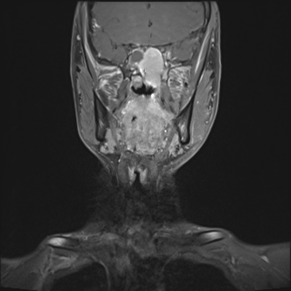 Nasopharyngeal carcinoma with skull base invasion (Radiopaedia 53415-59485 E 25).jpg