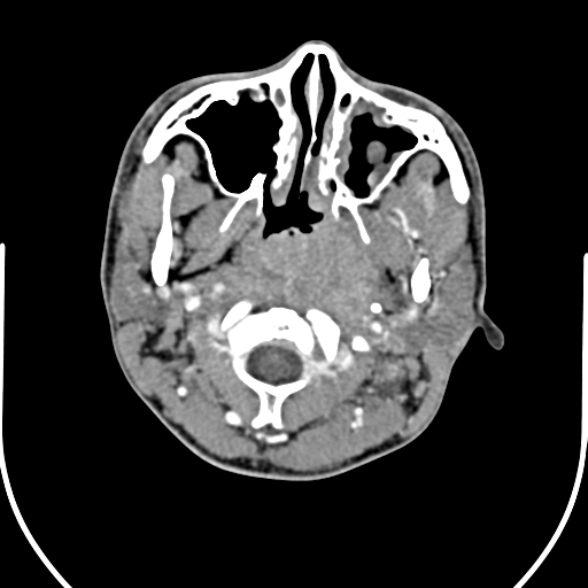 Nasopharyngeal carcinoma with skull base invasion (Radiopaedia 53415-59705 A 55).jpg