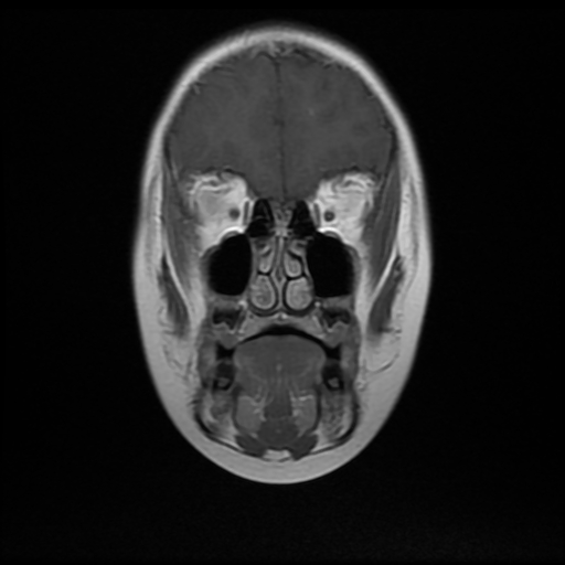 File:Nasopharyngeal rhabdomyosarcoma (Radiopaedia 23417-23486 Coronal T1 C+ 4).jpg