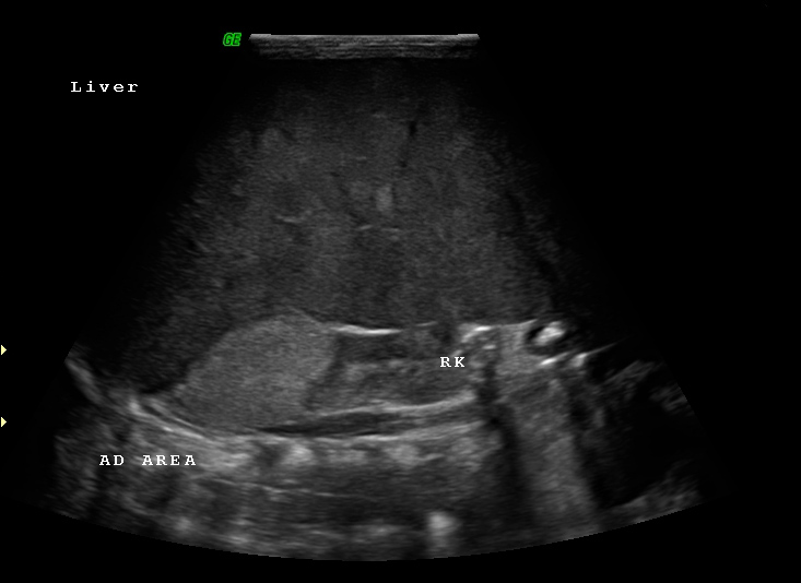 File:Neonatal neuroblastoma (Radiopaedia 9564-10221 A 10).jpg