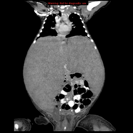 File:Neonatal neuroblastoma (Radiopaedia 9564-10223 B 63).jpg