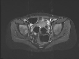 File:Neuroblastoma with bone metastases (Radiopaedia 67080-76414 Axial STIR 51).jpg