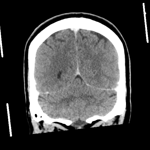 Neurocysticercosis - granular nodular (Radiopaedia 42786-45957 Coronal C+ 49).png