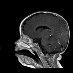 File:Neurofibromatosis type 1 (Radiopaedia 30089-30671 Sagittal T1 C+ 7).jpg