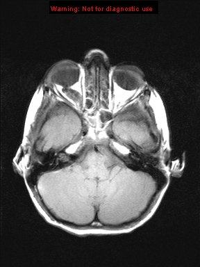 File:Neurofibromatosis type 1 with optic nerve glioma (Radiopaedia 16288-15965 Axial T1 19).jpg