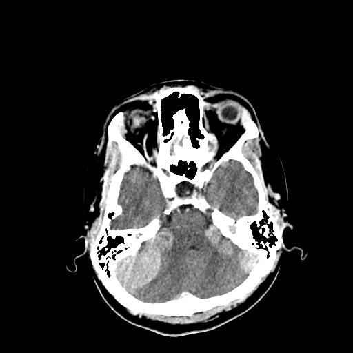 File:Neurofibromatosis type 2 (Radiopaedia 25389-25637 Axial C+ 18).jpg