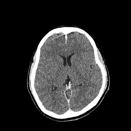 File:Neurofibromatosis type 2 (Radiopaedia 25389-25637 Axial C+ 48).jpg