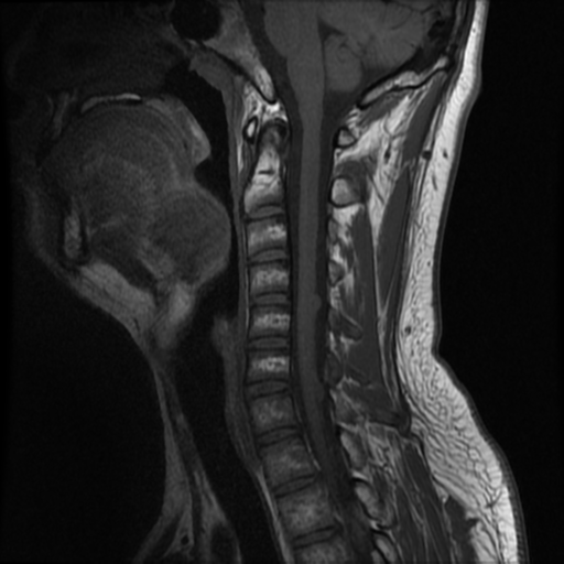File:Neurofibromatosis type 2 (Radiopaedia 44936-48837 Sagittal T1 9).png
