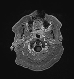Neurofibromatosis type 2 (Radiopaedia 79097-92049 Axial T1 C+ 22).jpg