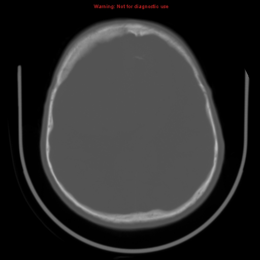 File:Neurofibromatosis type 2 (Radiopaedia 8953-9732 Axial bone window 24).jpg