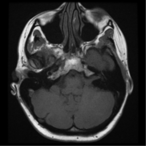 File:Neurofibromatosis type 2 - bilateral acoustic neuromata (Radiopaedia 40060-42566 Axial T1 6).png