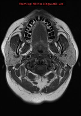 File:Neuroglial cyst (Radiopaedia 10713-11184 Axial T1 23).jpg