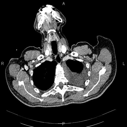 File:Non Hodgkin lymphoma in a patient with ankylosing spondylitis (Radiopaedia 84323-99621 B 6).jpg
