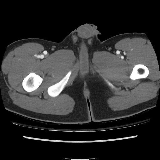 File:Normal CT angiogram of pelvis (Radiopaedia 45390-49430 A 60).jpg