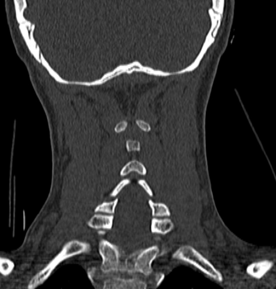 File:Normal CT cervical spine - 12-year-old (Radiopaedia 55352-61775 Coronal bone window 161).jpg