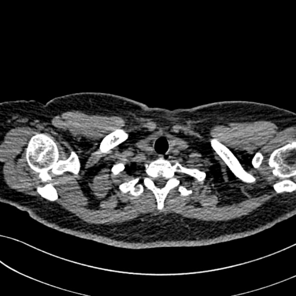 Normal CT chest- adult female (Radiopaedia 52522-58428 Axial non-contrast 11).jpg