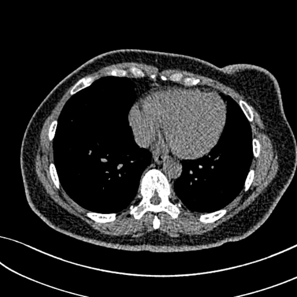 Normal CT chest- adult female (Radiopaedia 52522-58428 Axial non-contrast 89).jpg