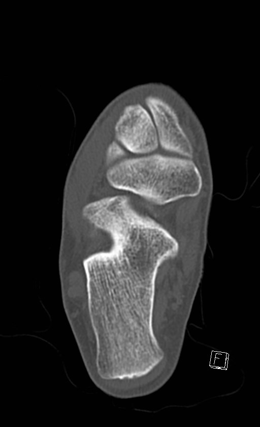 Normal CT of the ankle (Radiopaedia 47111-51658 Axial bone window 64).jpg