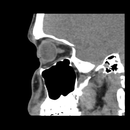 Normal CT paranasal sinuses (Radiopaedia 42286-45390 F 102).jpg