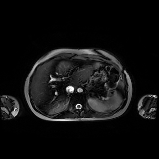 File:Normal MRI abdomen in pregnancy (Radiopaedia 88001-104541 Axial Gradient Echo 10).jpg