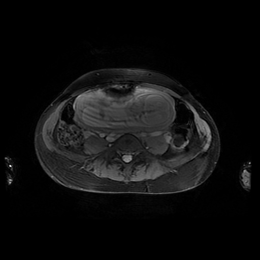 File:Normal MRI abdomen in pregnancy (Radiopaedia 88001-104541 D 35).jpg