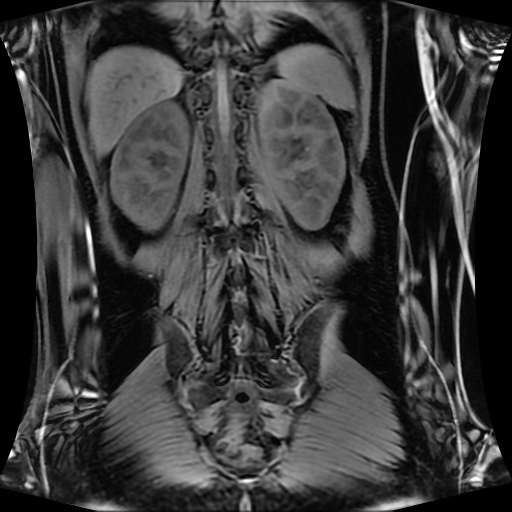 Normal MRI abdomen in pregnancy (Radiopaedia 88001-104541 M 108).jpg