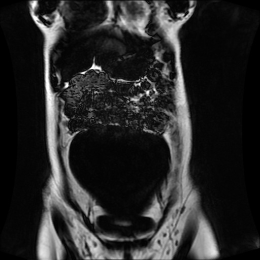 Normal MRI abdomen in pregnancy (Radiopaedia 88001-104541 N 41).jpg