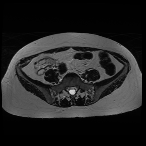 Normal MRI abdomen in pregnancy (Radiopaedia 88005-104548 Axial T2 15).jpg
