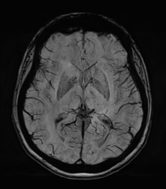 Normal MRI internal auditory canal (Radiopaedia 41613-44525 Axial SWI MIP 40).png