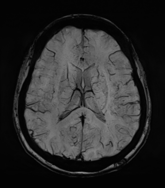 Normal MRI internal auditory canal (Radiopaedia 41613-44525 Axial SWI MIP 47).png