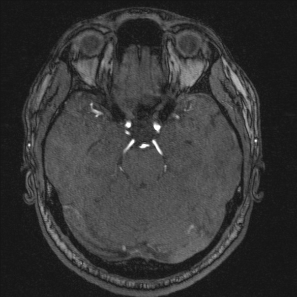 Normal brain MRI including MRA (Radiopaedia 48748-53763 Axial MRA 74).jpg