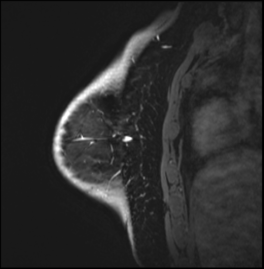Normal breast MRI - dense breasts (Radiopaedia 80454-93850 I 147).jpg